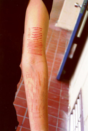 bellies. Some people self-injure by burning their skin with the end of ...