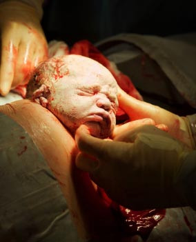 Induced labor doubles the odds of C-Section