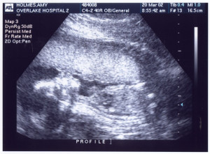 Baby Ultrasound Girl Vary From