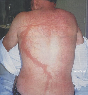 What Does It Look Like When A Person Gets Struck By Lightning?