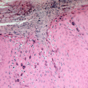 Verruca Vulgaris Eyelid Verucca vulgaris (wart)