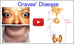 Graves-Disease-Hyperthyroidism-Explained-Made-Easy-Medical-Institution ...