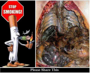 Cigarette smoking weakens bones