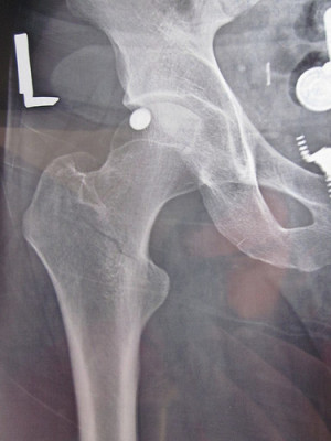femur bone to heal broken femur bone recovery time x ray of broken ...
