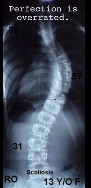 Scoliosis - Perfection is overrated.