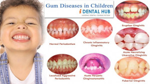 Gum and periodontal diseases can occur in children. Various gum ...