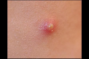 Image of Pimple