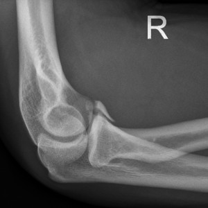 ray of Elbow Coronoid Process Fracture