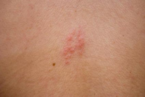 mild shingles rash on arm shingles rash early stages