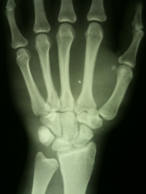 Hand Wrist Bones X Ray