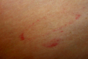 Lyme Disease Bullseye Rash