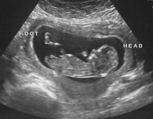 Baby Heads Twins Ultrasound...
