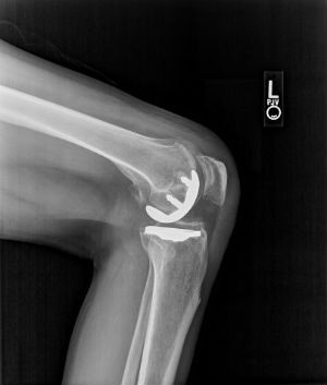 Total and Partial Knee Replacement or Arthroplasty