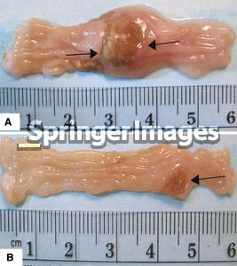 ulcer within the distal 4 cm segment of the rat colon Colonic
