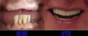 Smile Gallery Full Mouth Rehabilitation with Dental Implants