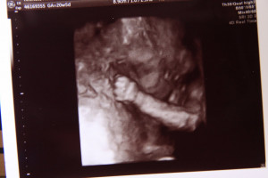 4d Ultrasound Of Baby With Down Syndrome Do 3d ultrasounds.