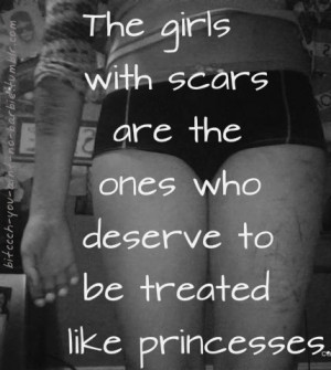 girls princess scars treated