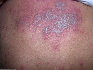 Related to What Is Disseminated Herpes Zoster With Pictures