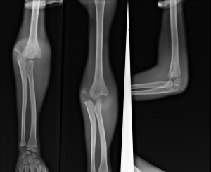 Pediatric Elbow Fracture X ray