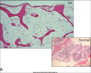 ... bone marrow aplastic anemia bone marrow vs normal improvement in bone