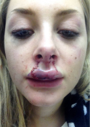 PHOTOS: Teen girl shares injuries after her boyfriend bites her lip in ...