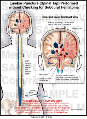 Lumbar Puncture (Spinal Tap) Performed without Checking for Subdural ...