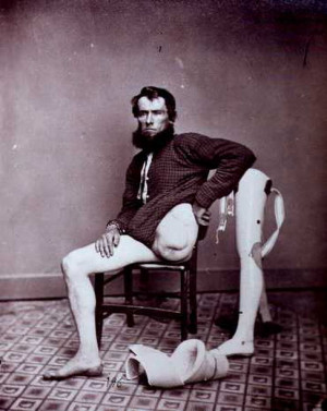 wounded Union soldier poses with his new prosthetic leg.