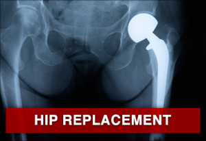 The Benefits of Hip Replacement Surgery