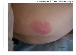 Stage 1 Pressure Ulcer Buttocks