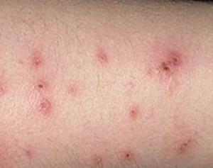Bed Bugs Bite Marks Treatment