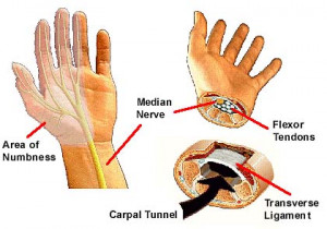 carpal tunnel syndrome - Computer Definition