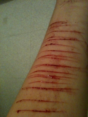 Self Harm Cuts On Arm