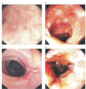 Endoscopic spectrum of Crohn disease includes (a) aphthous ulcerations ...