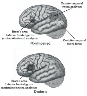 Figure 3. Areas of the brain affect by dyslexia. Figure4. MRI scans of ...