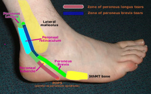Disorders of the peroneal tendons have been reported infrequently.