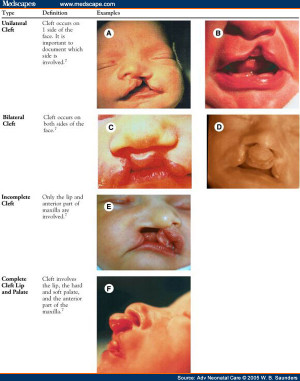 Cleft Lip and Palate Types