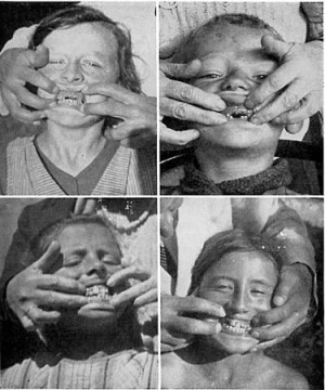 FIG. 3. Normal design of face and dental arches when adequate ...