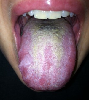 Thrush in Mouth Symptoms in Adults