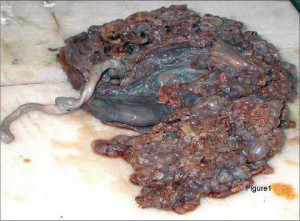 Learn More About Hydatidiform Mole – a False Pregnancy