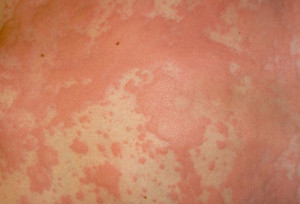 Sun Allergy Rash Causes...