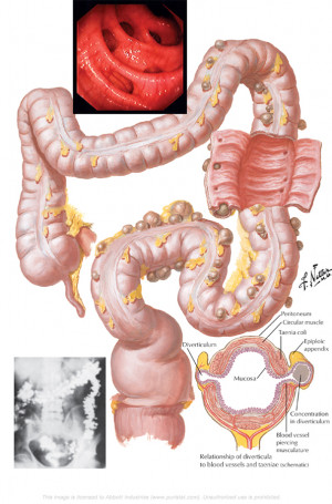 Colon Diverticulitis