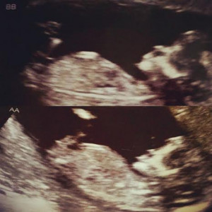 identical twins 13 weeks **updated** in Ultrasound Gender ...