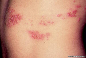 Herpes zoster syn shingles
