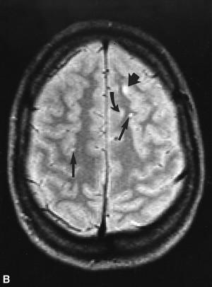 White Lesions On Brain MRI MS