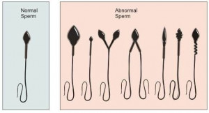 comparison of normal sperm and abnormal sperm