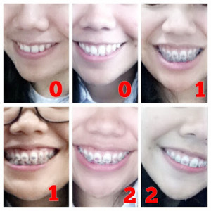 Well, I've just been using braces since 2 months ago. It looks like I ...