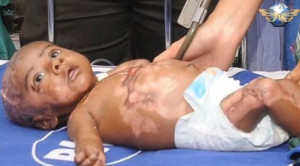 ... Indian Baby Catches Fire Without Provocation, Doctors Investigate
