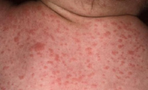 Lamictal rash – Symptoms, Treatment, Images
