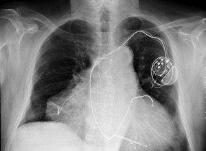 ... suffering from two irregular heart beats. His chest X-ray is pictured
