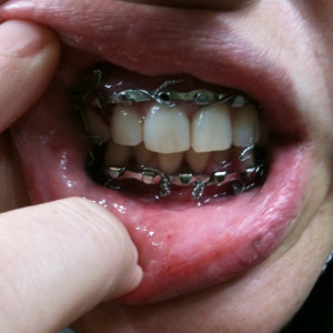 Broken Jaw Wired Shut Eat Got my mouth wired shut!